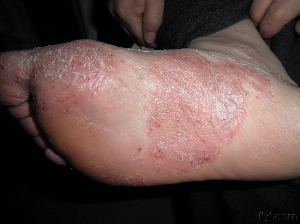 系列皮肤病——掌跖脓疱症