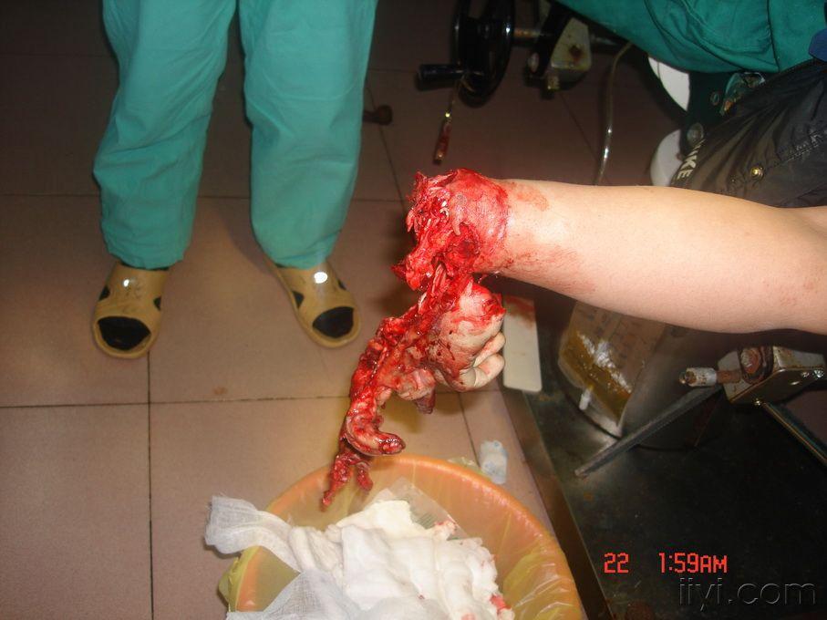 经典之作精彩再续双手毁损伤再造右手拇食指莆田wu警8710韩医生作品