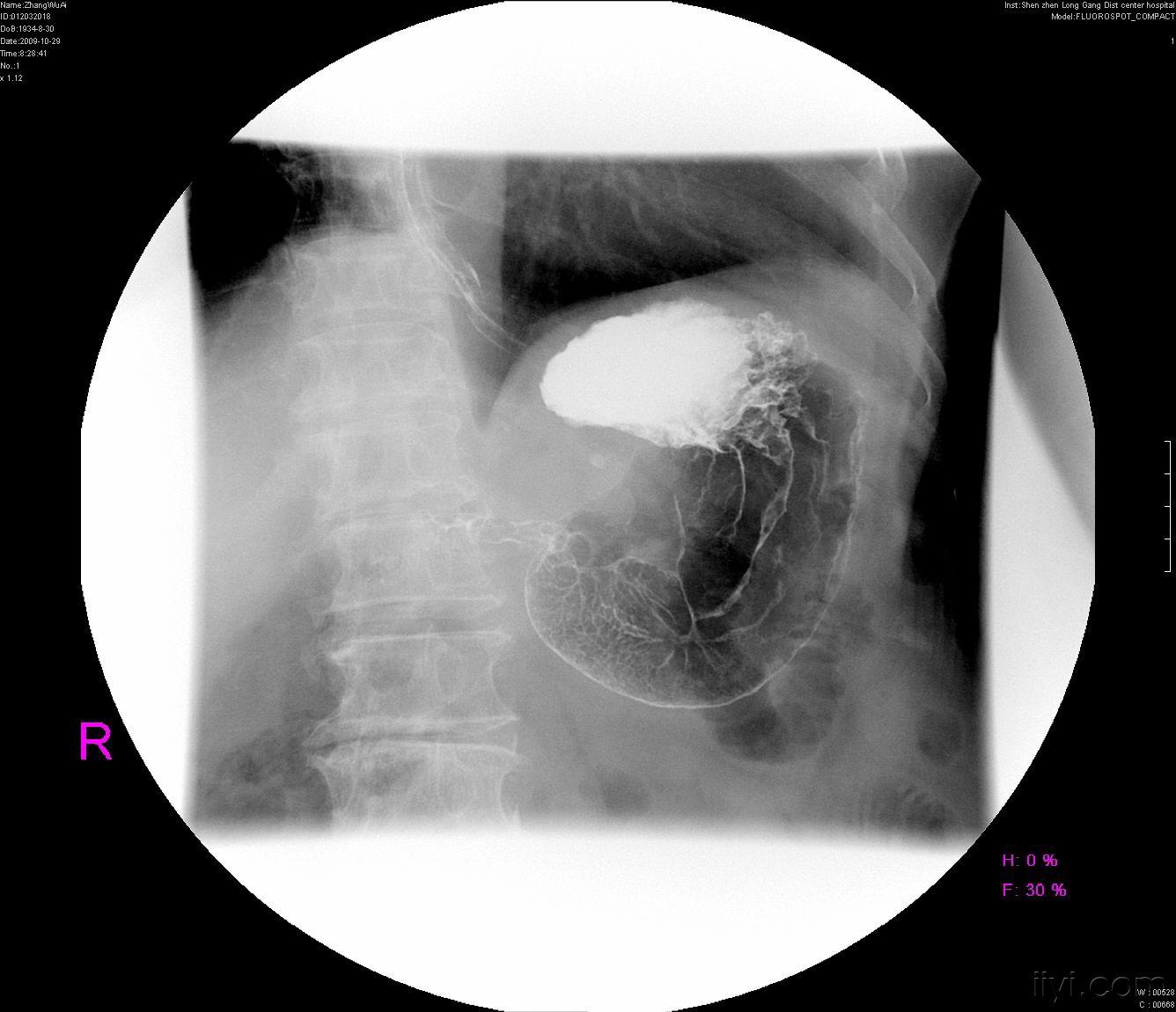 胃溃疡x线表现图片