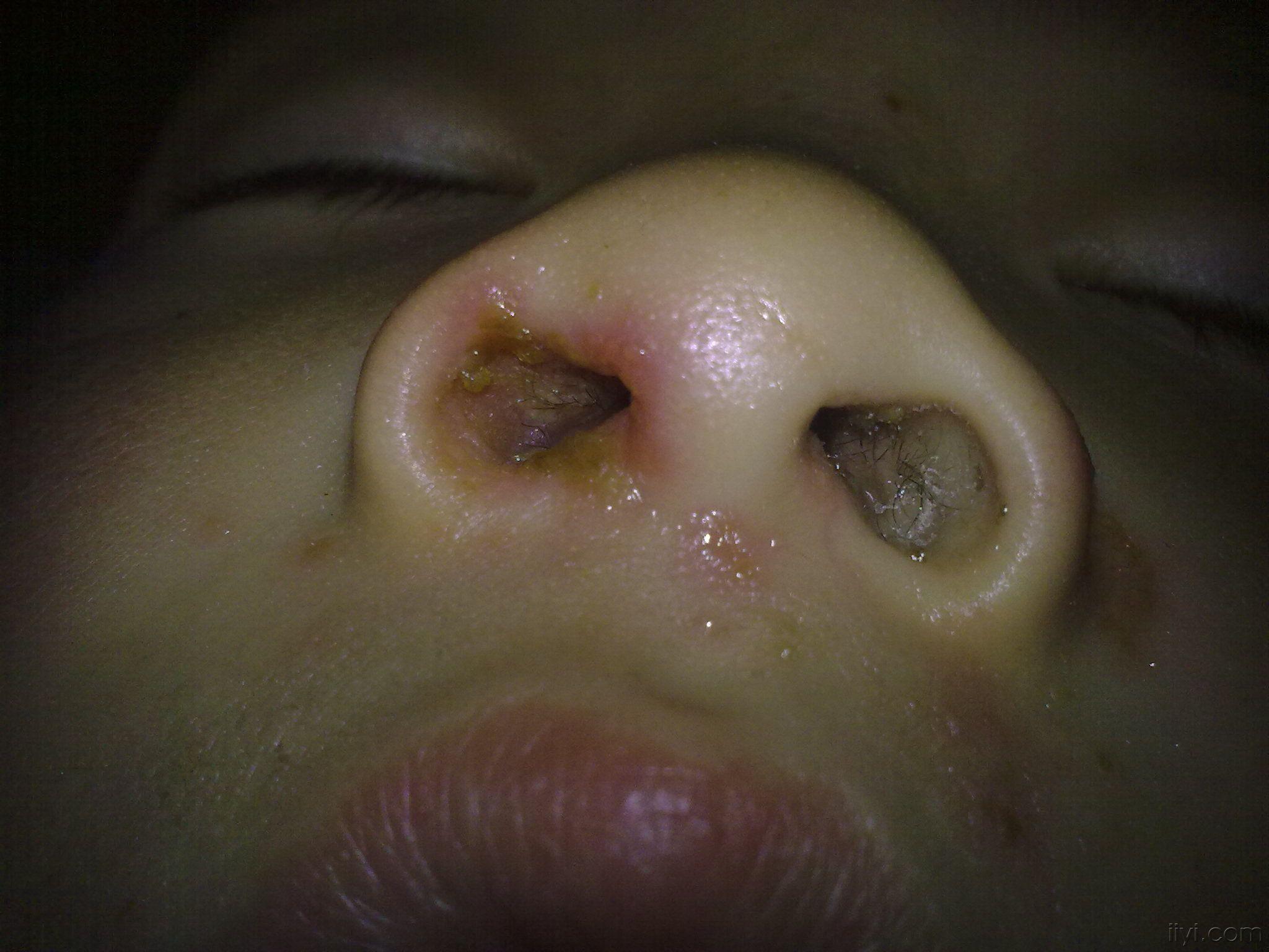 鼻子上水泡型疱疹图片图片
