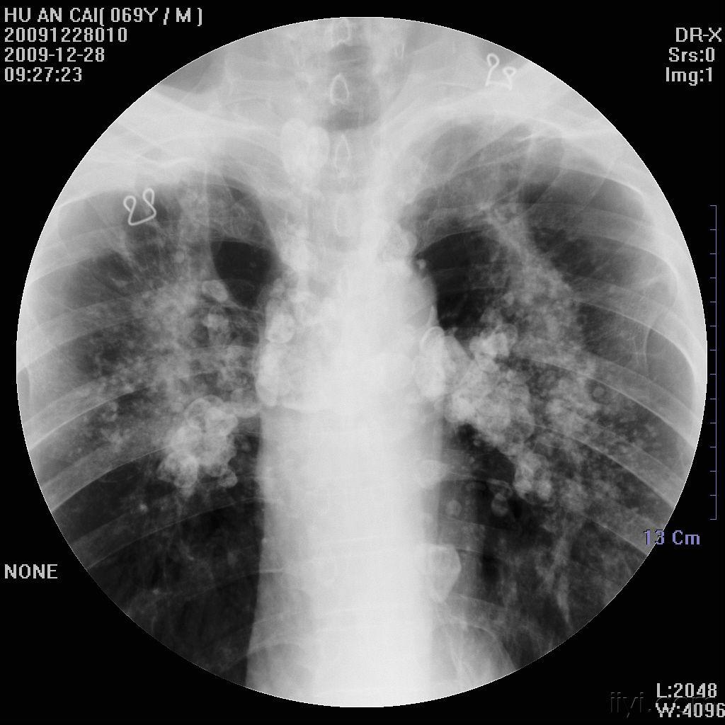 硅肺x线图片图片
