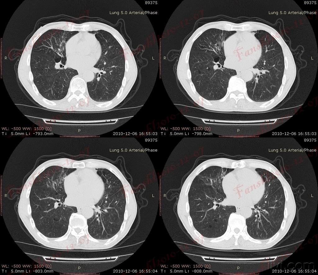男性70岁慢性支气管炎数十年