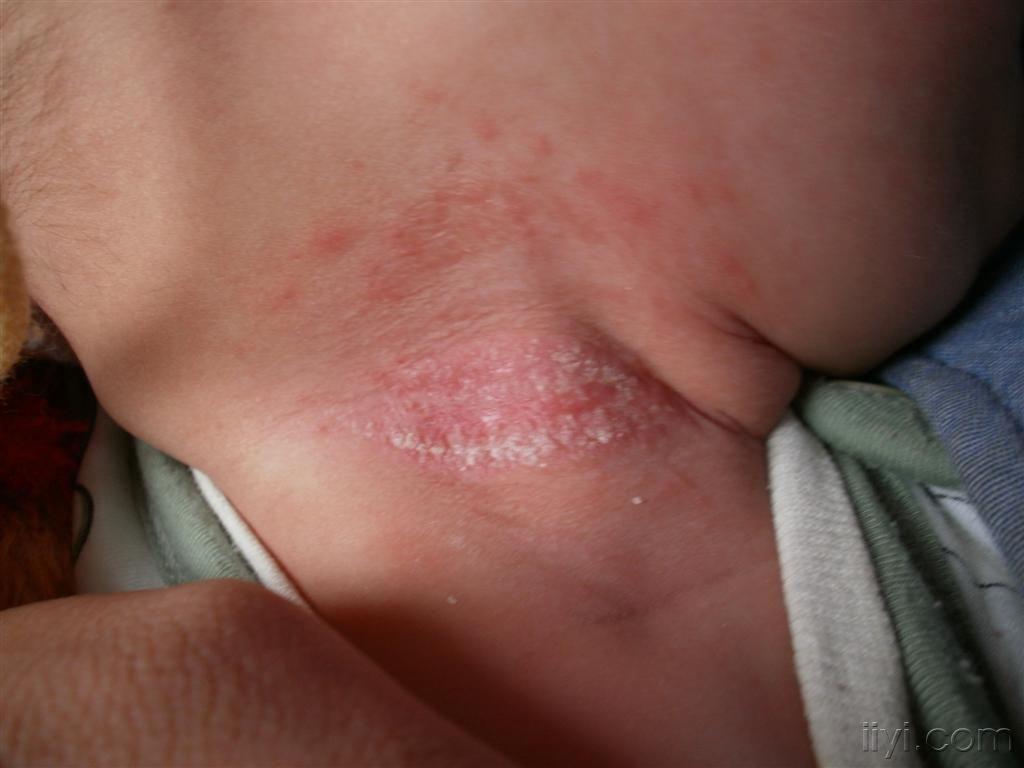 小孩霉菌感染症状图片图片