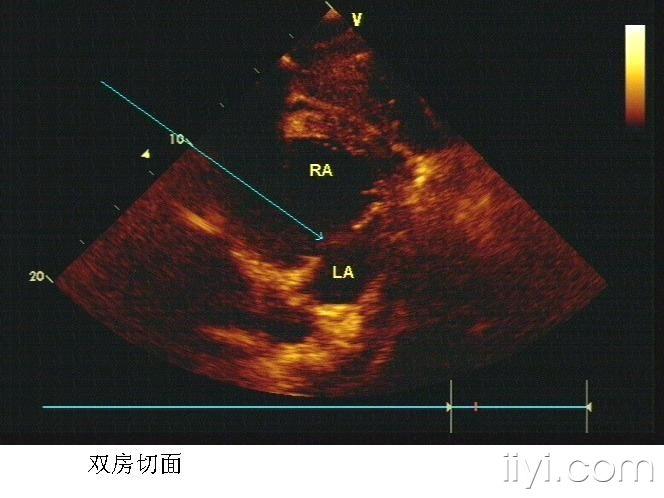 房间隔缺损(继发孔型) - 超声医学讨论版 - 爱爱医医学论坛