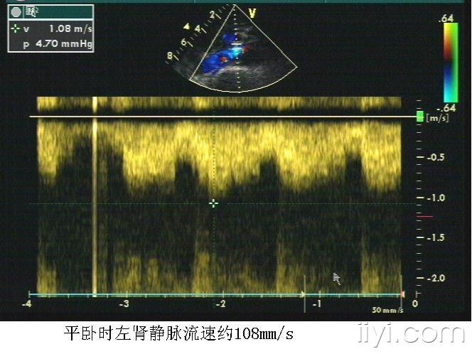 胡桃夹超声图片图片