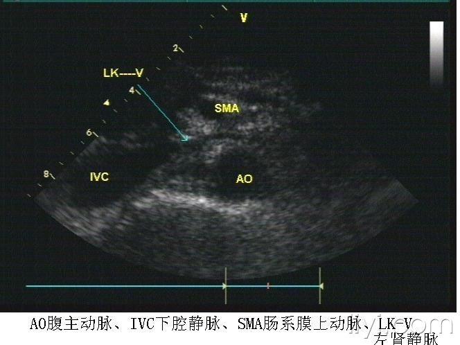 胡桃夹综合征超声表现图片