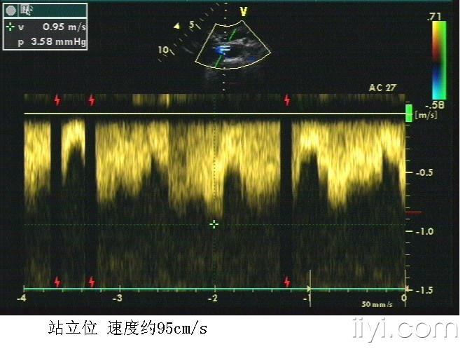 胡桃夹综合征超声表现图片