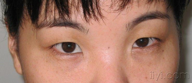 求助眼角开大术后的内眦凹陷性瘢痕如何处理