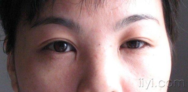 求助眼角开大术后的内眦凹陷性瘢痕如何处理