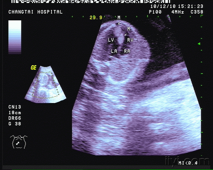 胎儿心脏横纹肌瘤? 
