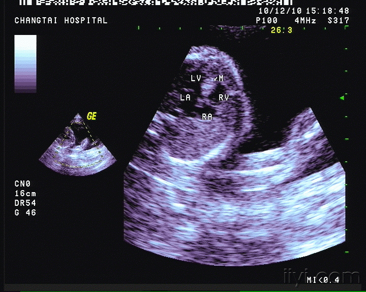 胎儿心脏横纹肌瘤?