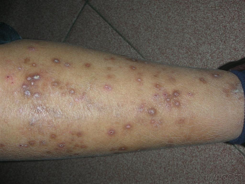 结节性痒疹五个阶段图片