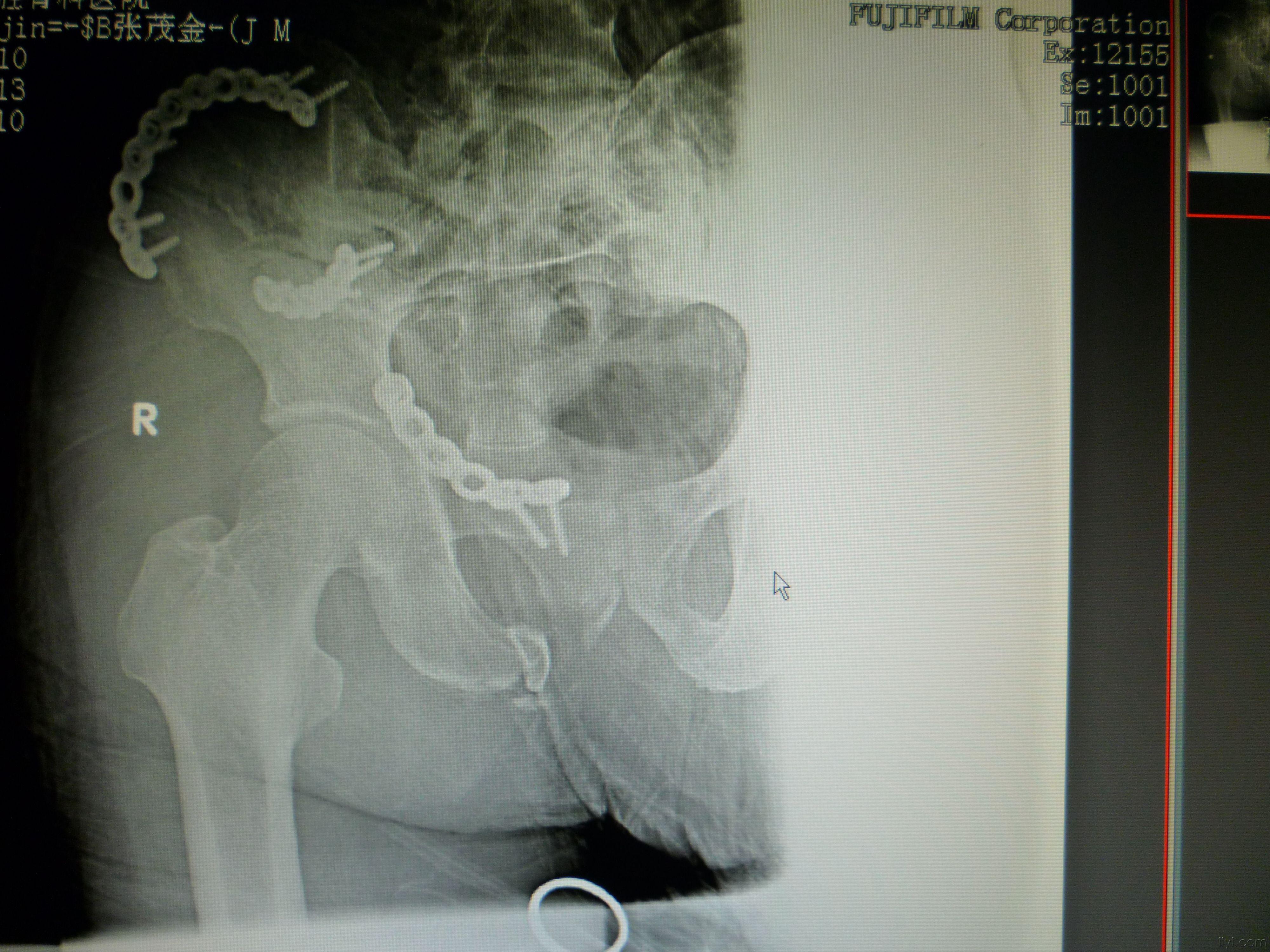 骨盆粉碎性骨折治疗