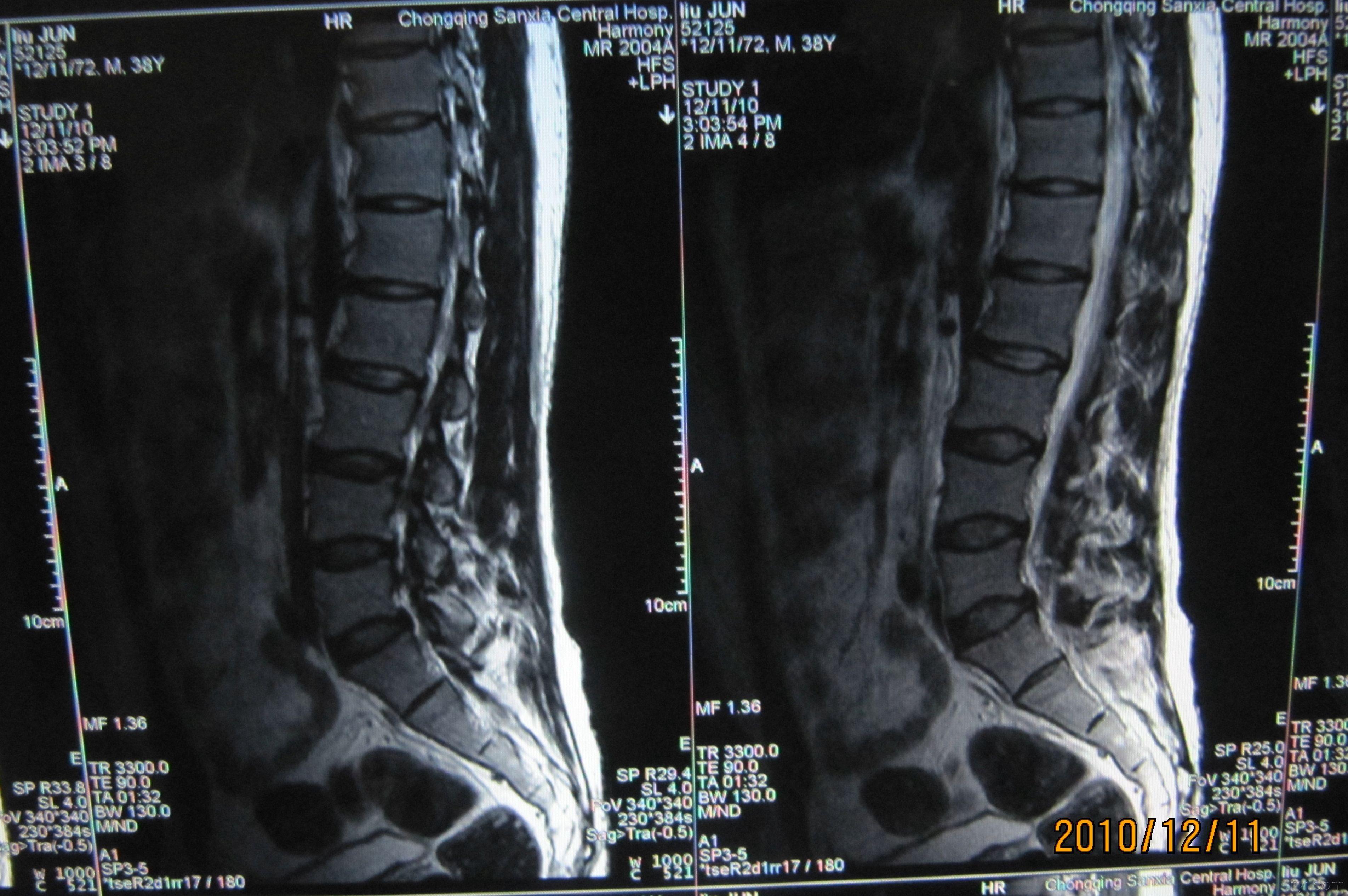 請老師幫我看下胸腰椎核磁共振片