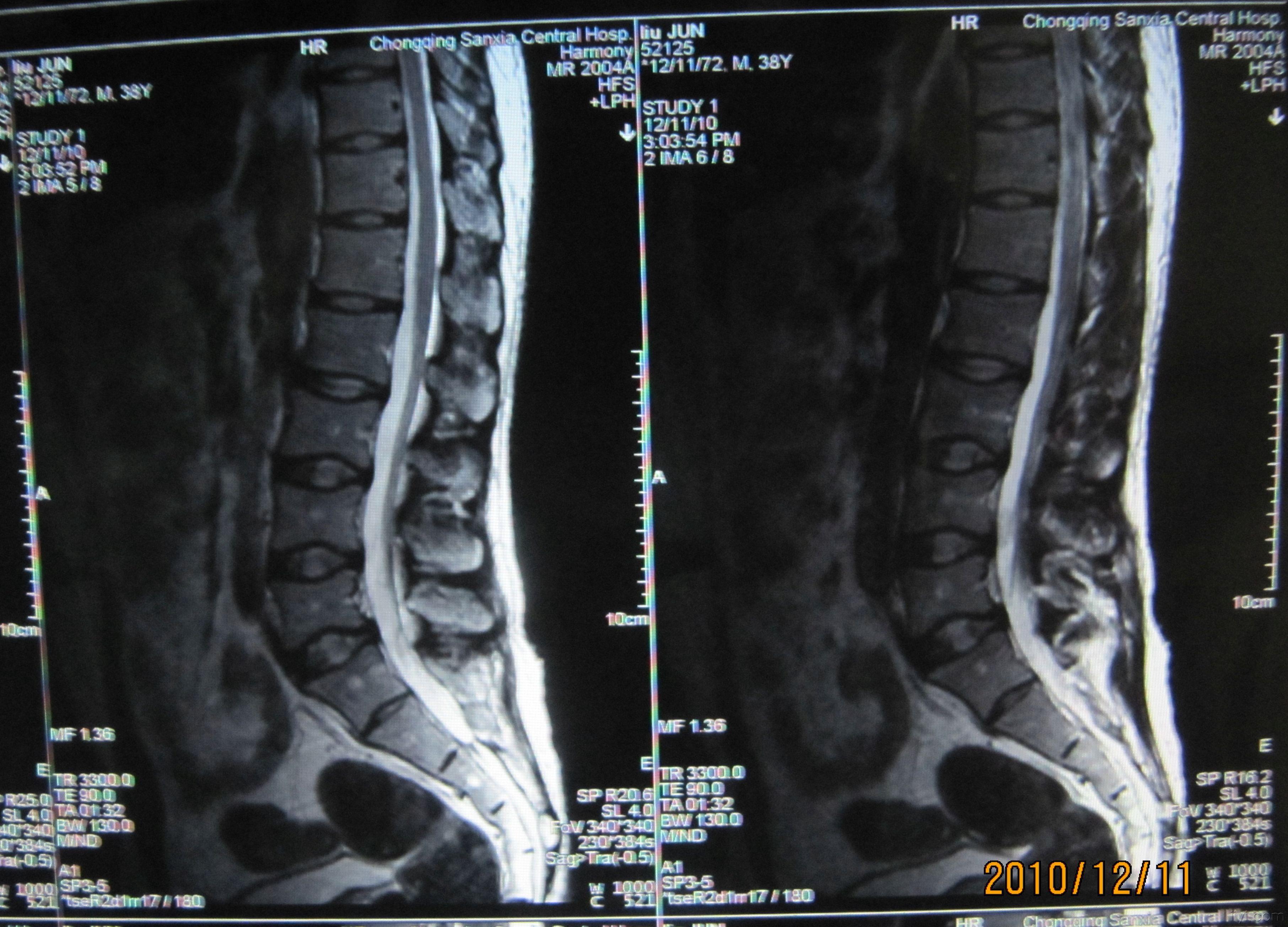 腰椎的核磁共振成像图片....请专家帮我看下_百度知道