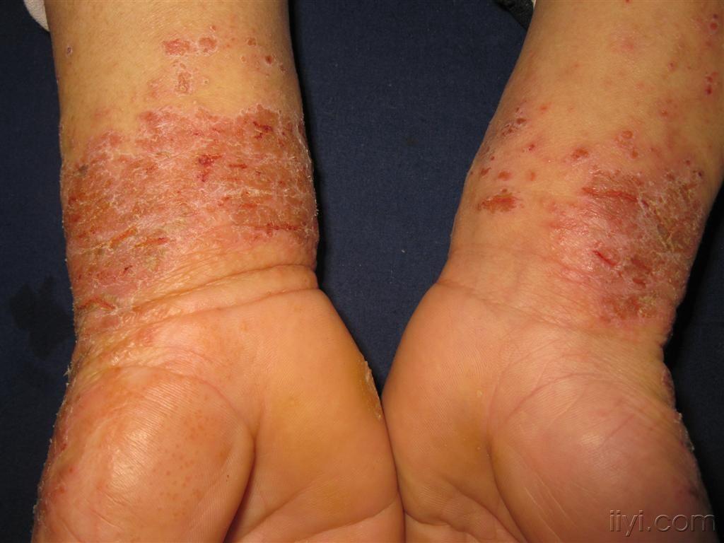 看图识病------接触性皮炎 - 皮肤及性传播疾病讨论版 - 爱爱医医学