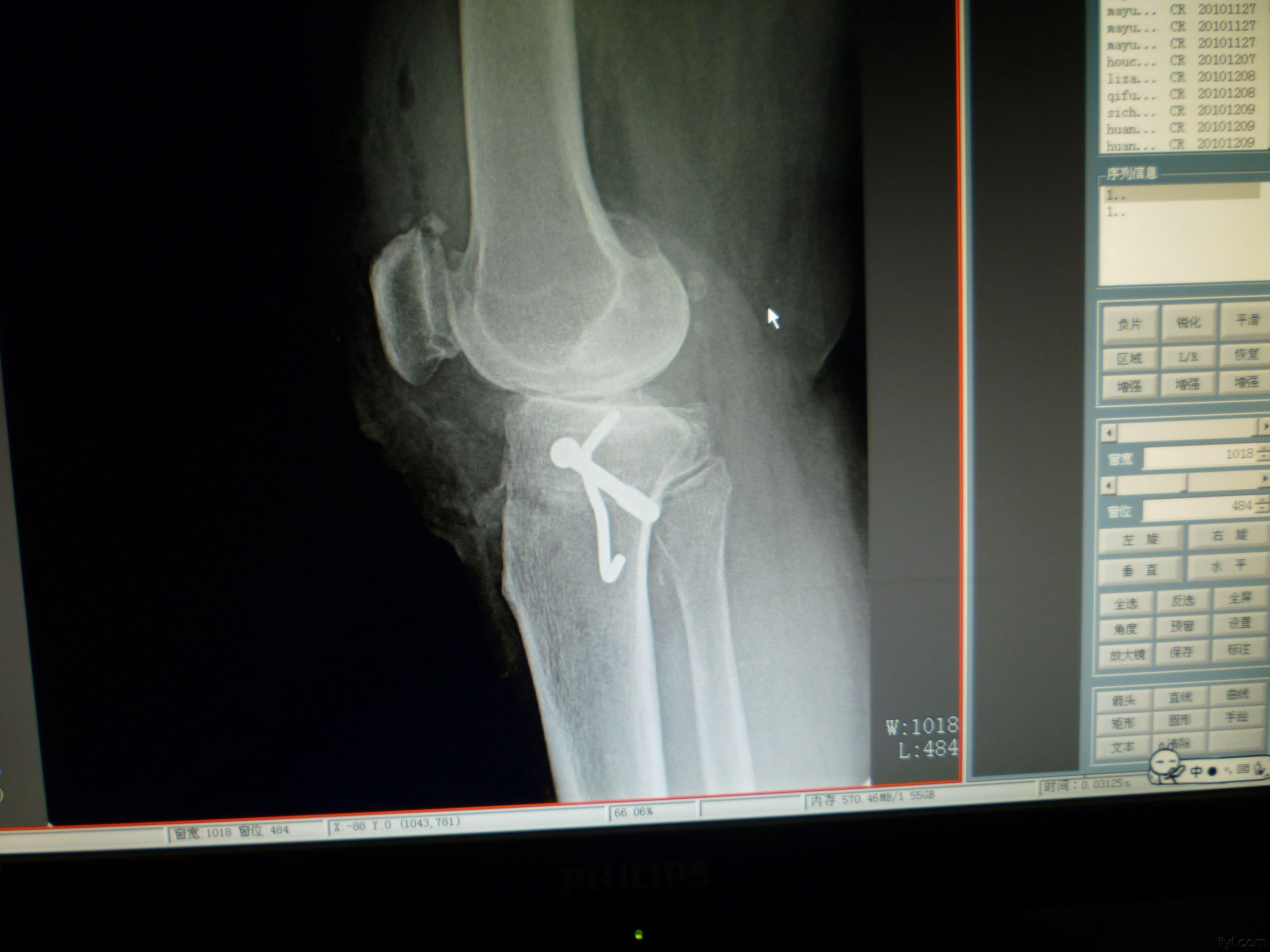 膝关节退行性变膝内翻矫形骑缝钉内固定