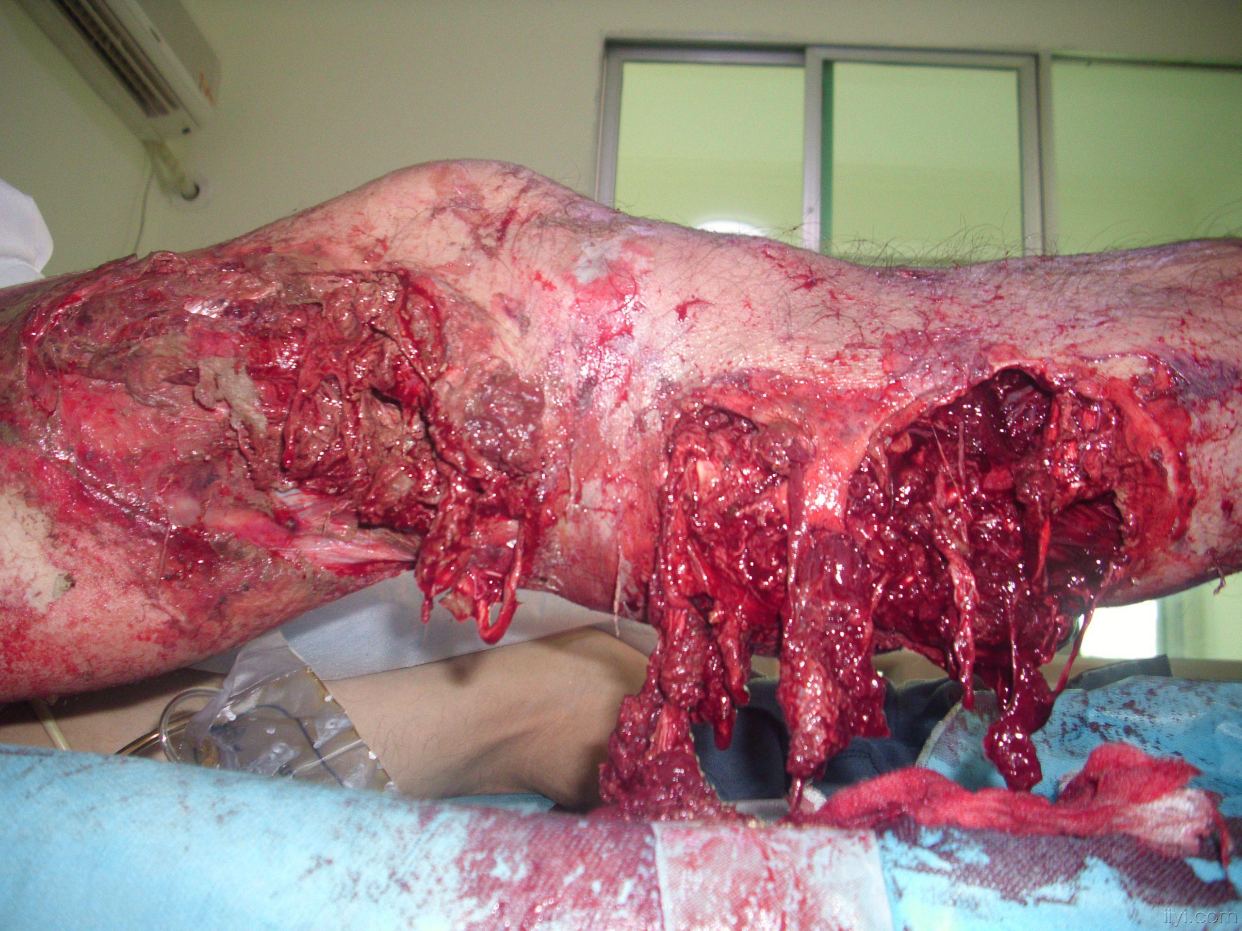 车祸致右下肢毁损伤