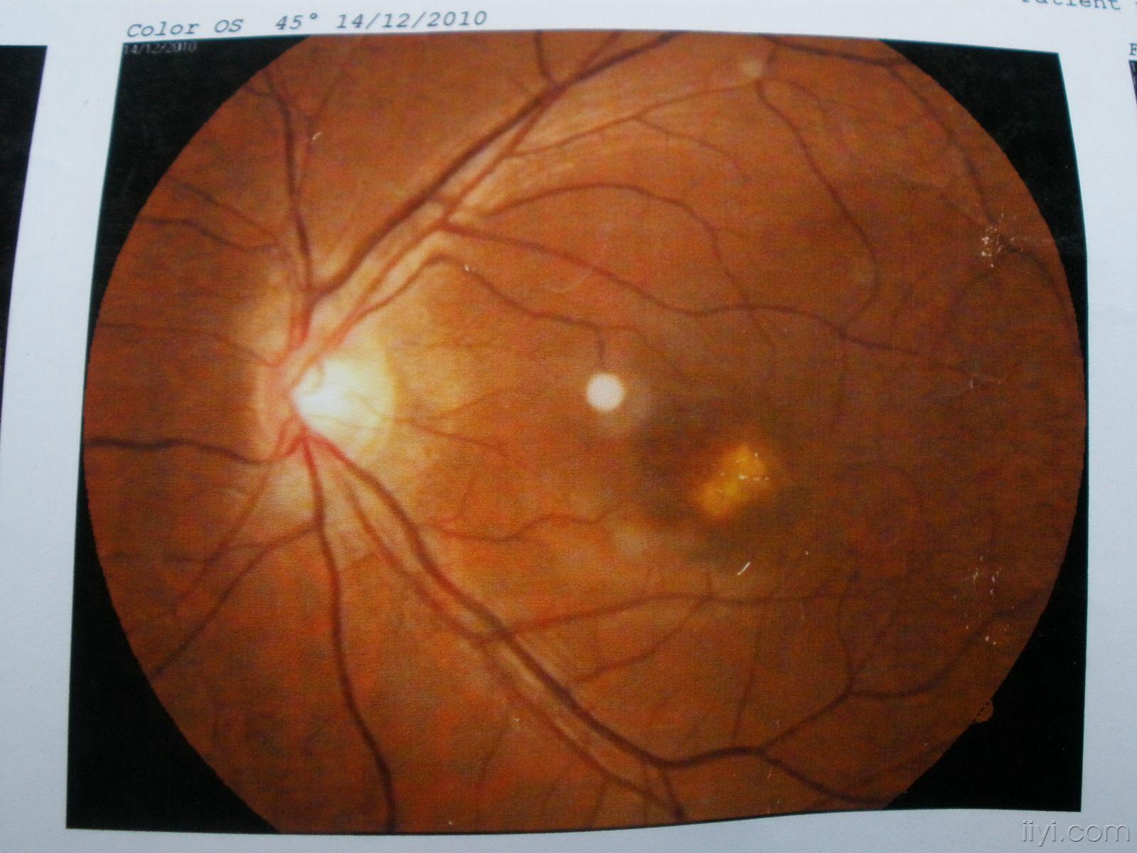 视网膜黄斑病的治疗