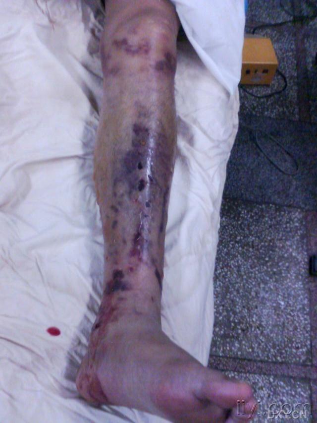 昨天切的一例骨筋膜室综合征