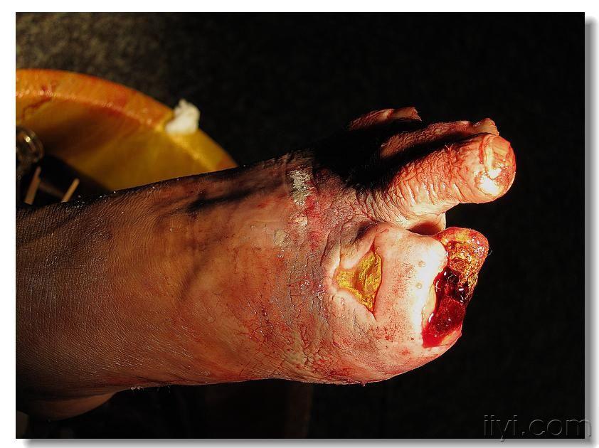脚趾坏死附图