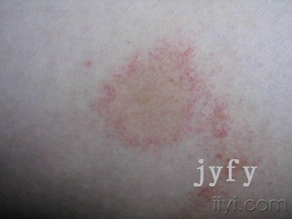 皮肤病双下肢环状皮损