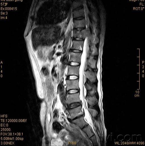 4# wwsh901 胸腰椎mri檢查提示:t11椎體病理性骨折