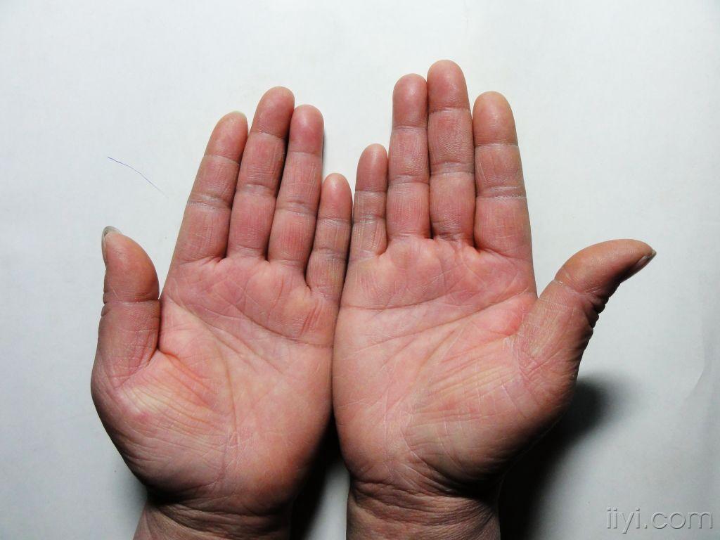 右手背指背红斑二年无自觉症状无季节性