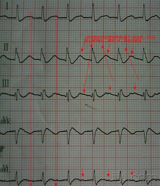 帮忙看看窦性心动过速阵发性室上速还是其他