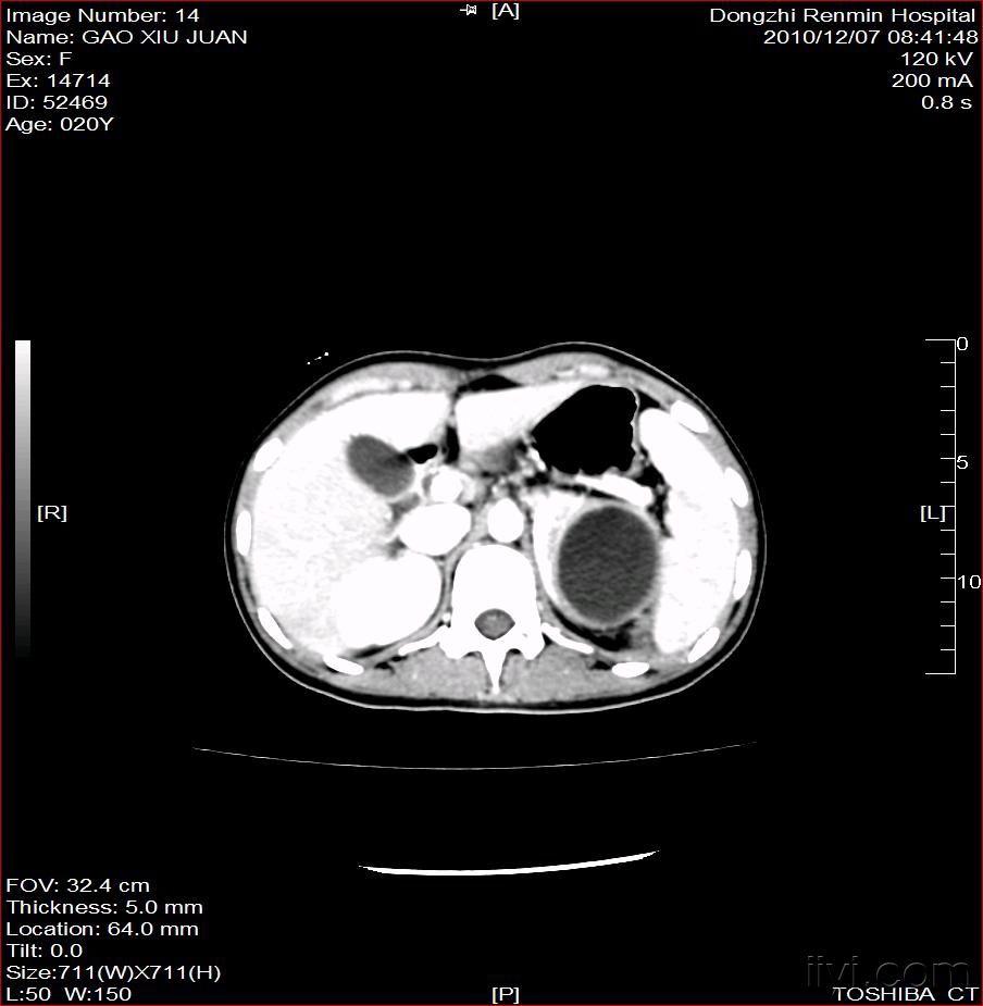 左肾脓肿(附图)