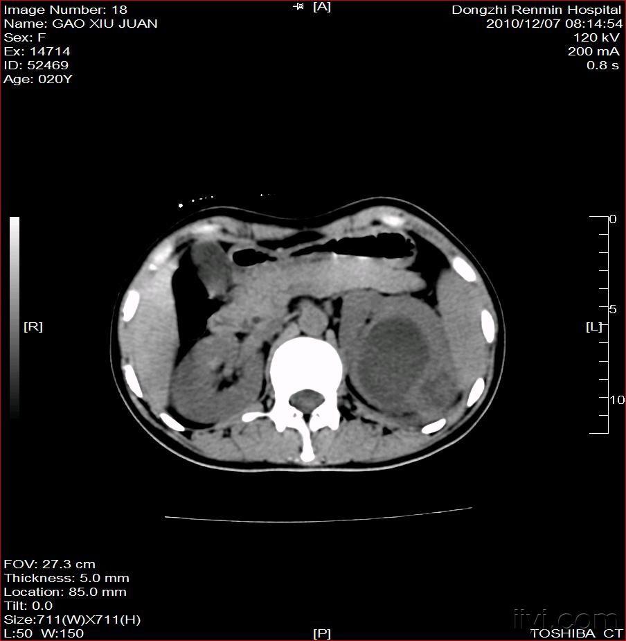 肾周围脓肿图片