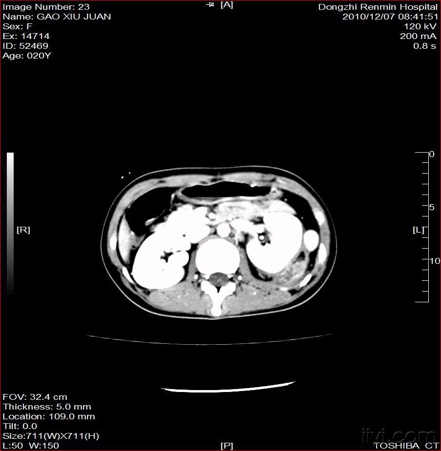 左肾脓肿(附图)