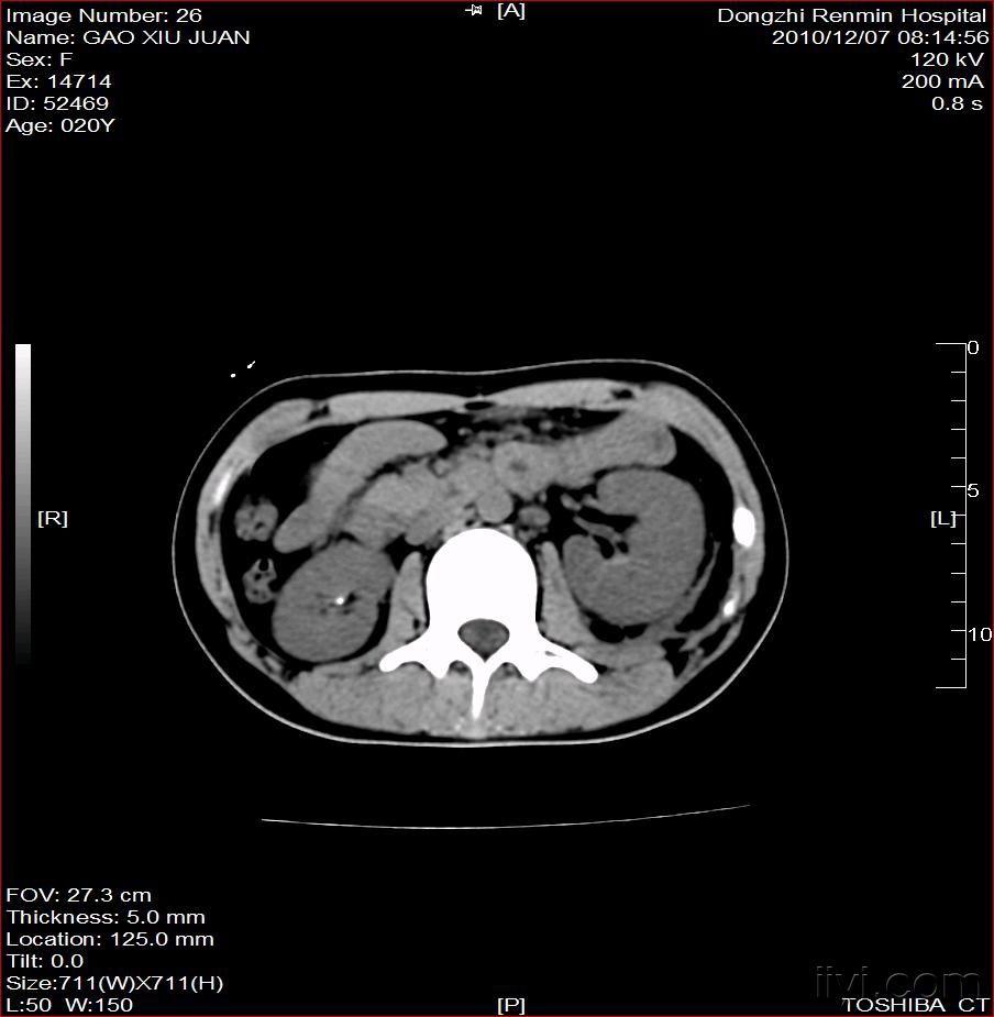 左肾脓肿(附图)