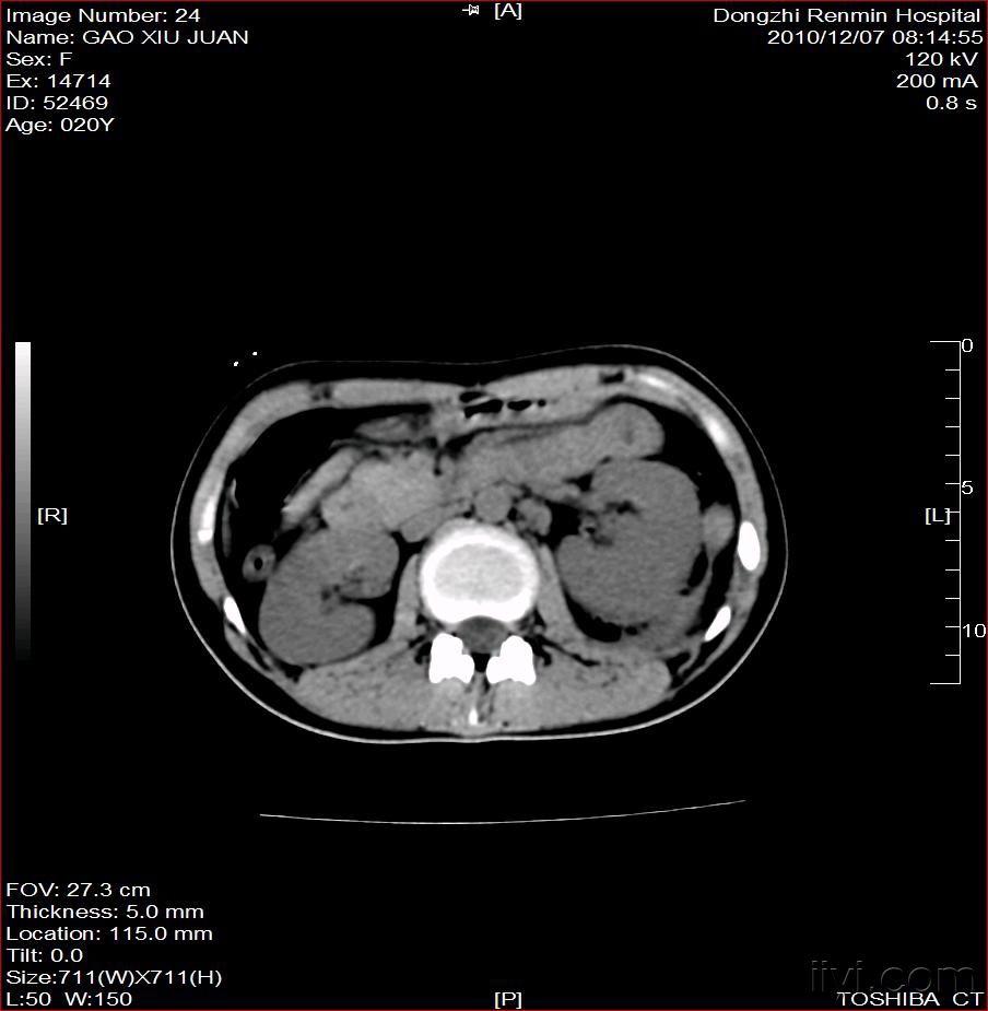 左肾脓肿(附图)