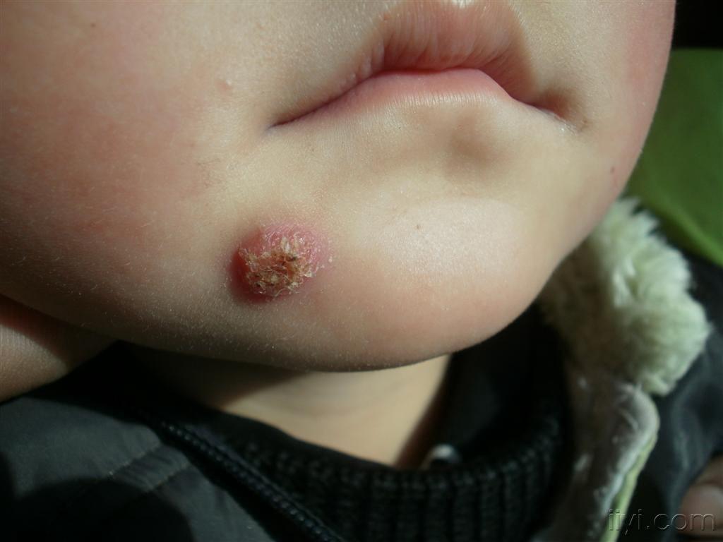 小孩霉菌感染症状图片图片
