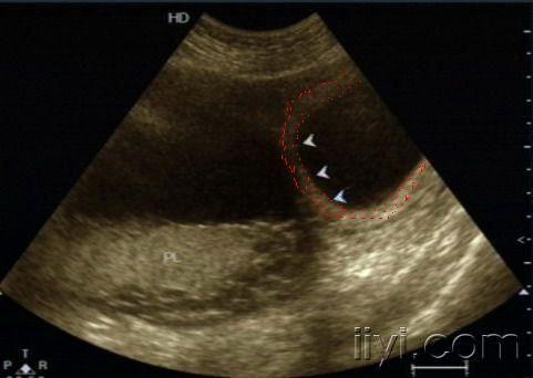 宫腔内带状回声,考虑轮状胎盘?