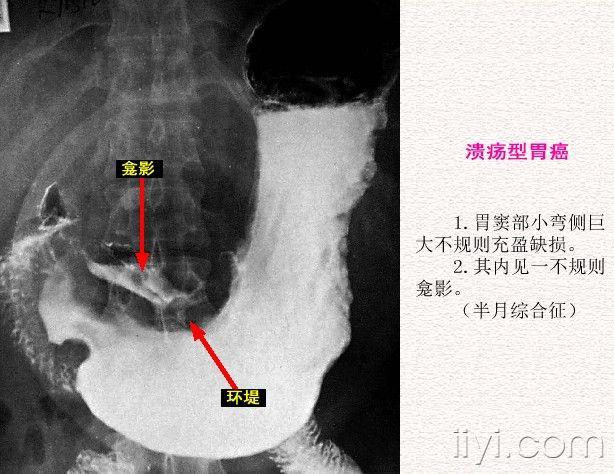胃癌半月综合征图片