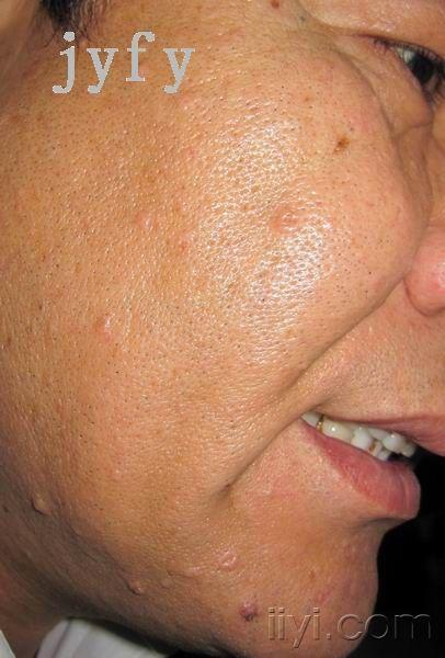 圣诞快乐-老年性皮脂腺增生