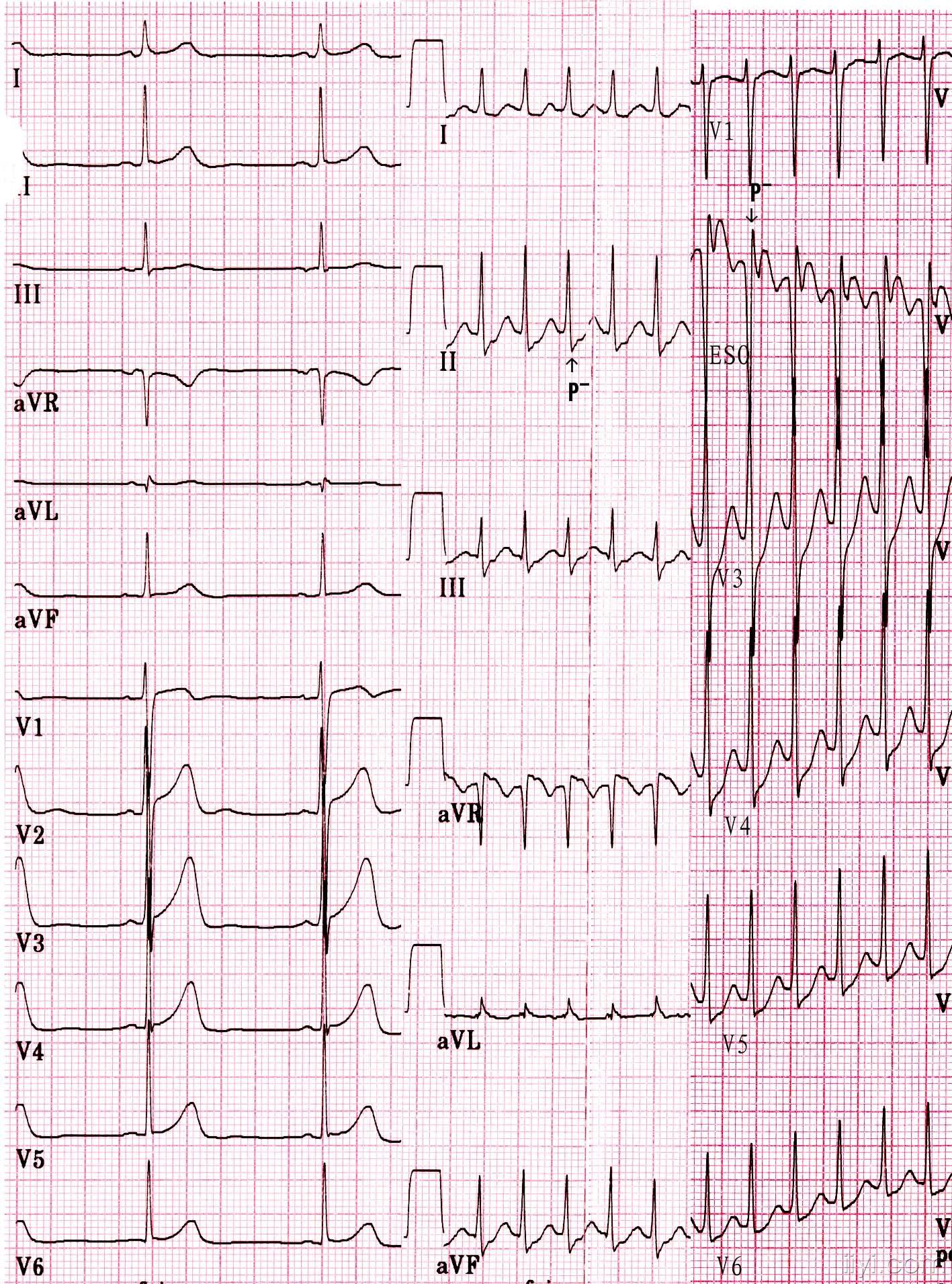 室上速典型心电图图片