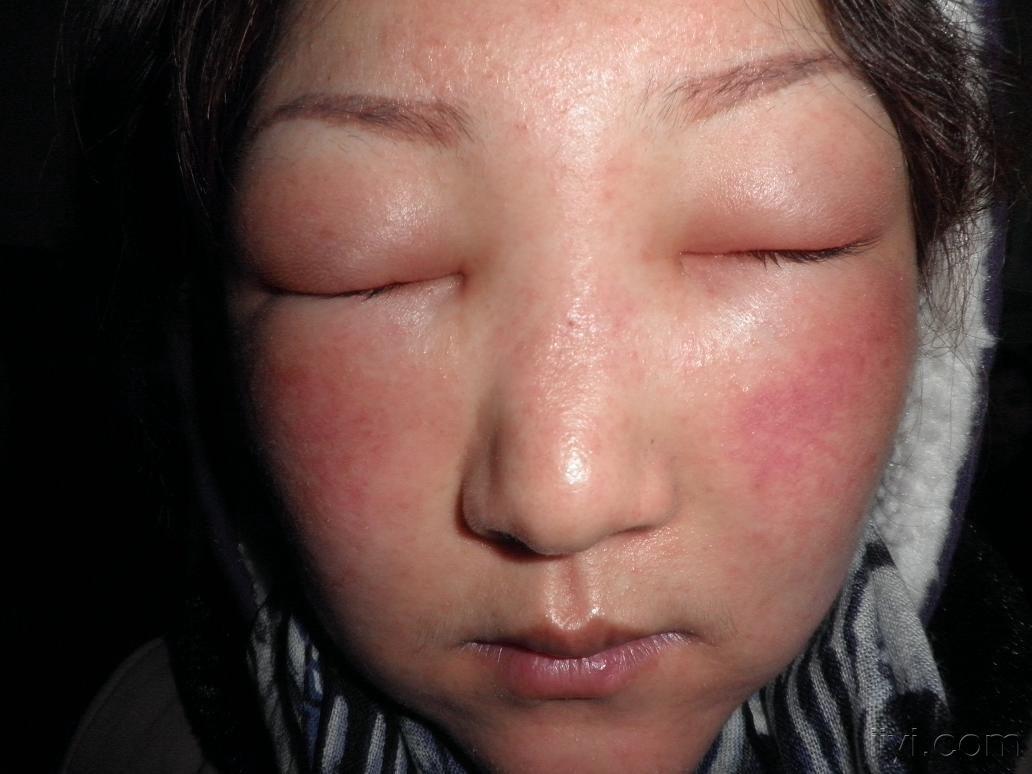 系列皮肤病化妆品皮炎