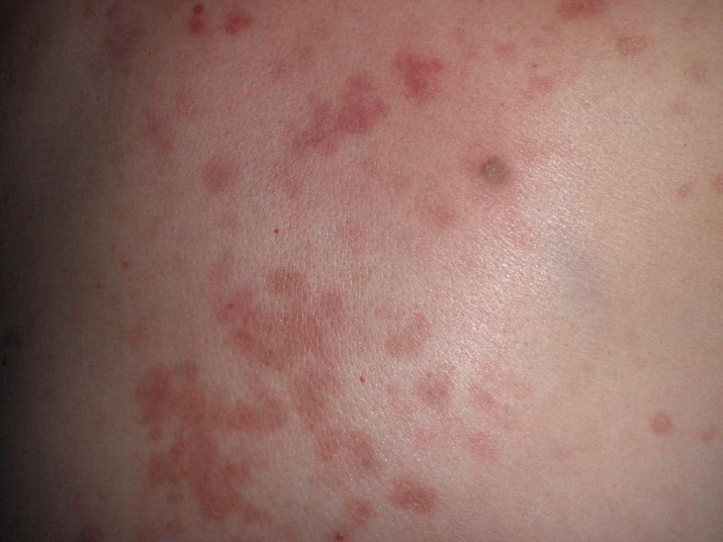 后背皮疹
