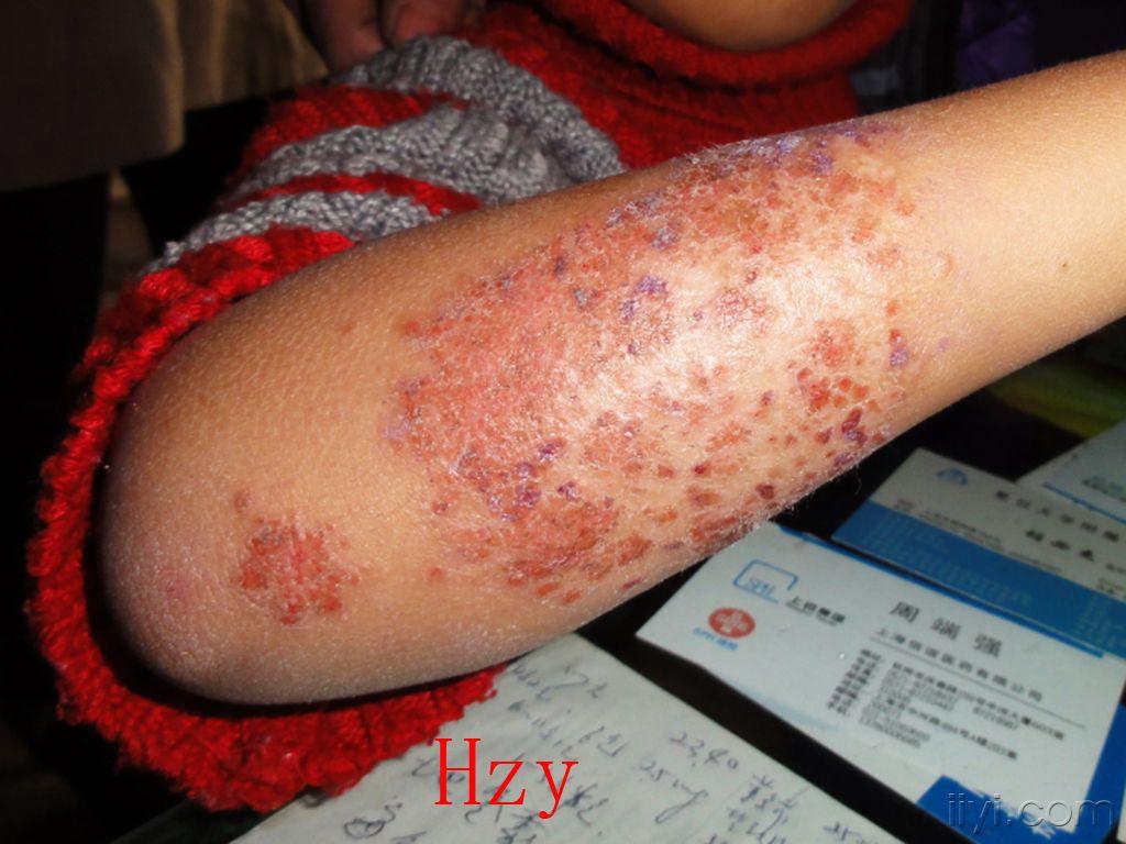看这小儿的皮损湿疹