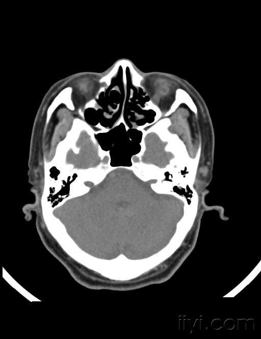 造釉细胞瘤ct图片图片