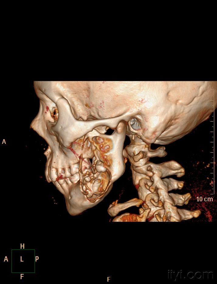 颌骨肿瘤症状图片图片