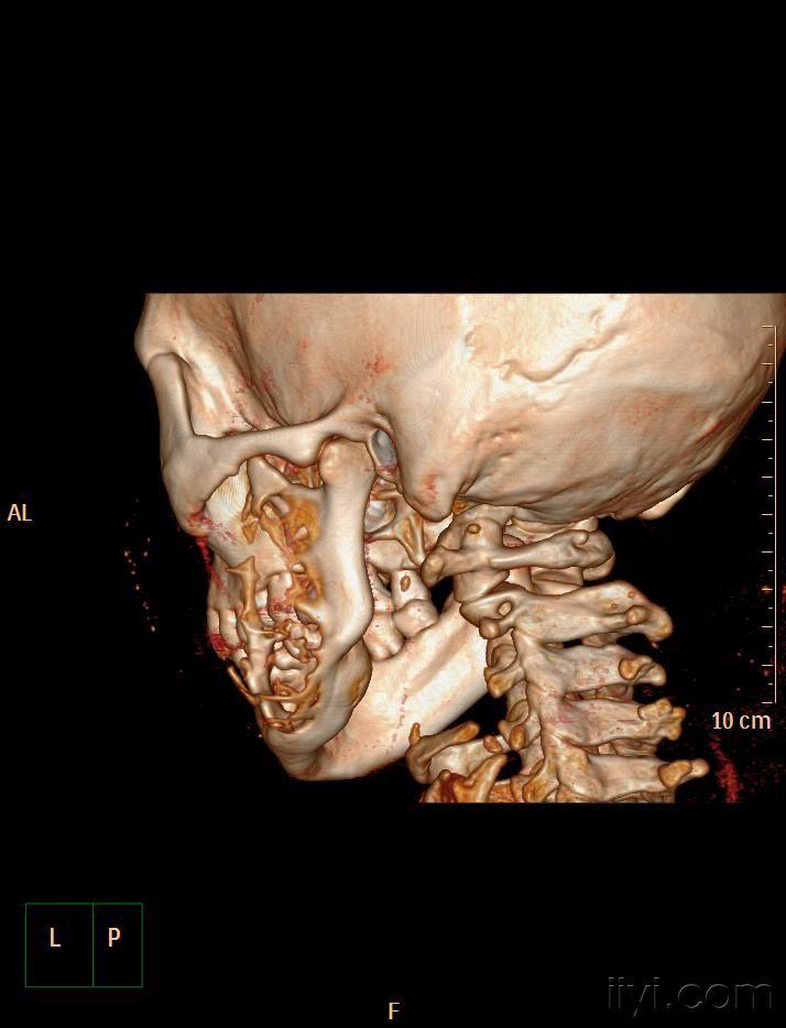 下颌骨病例有病理病理结果造釉细胞瘤