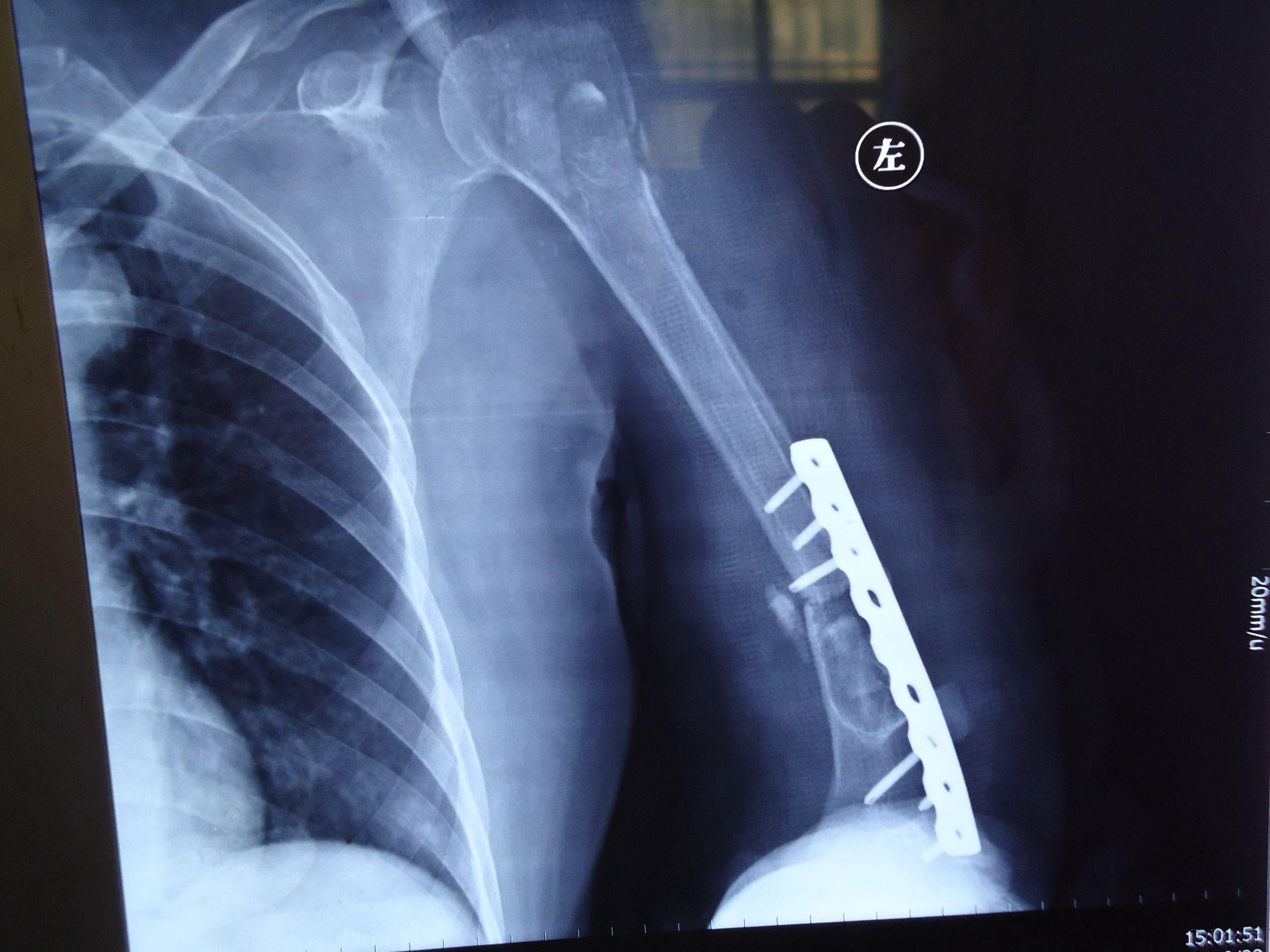 植骨 钢板内固定术后