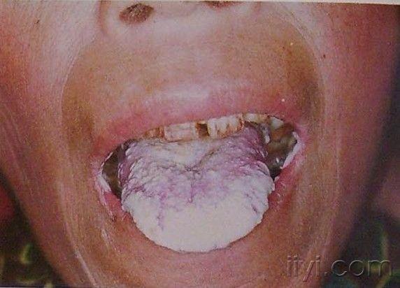 口腔假膜是什么样的图片