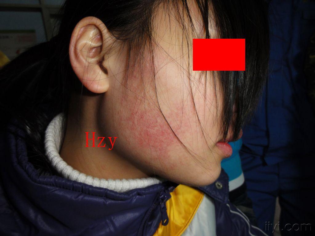面颈毛囊性红斑黑变病图片