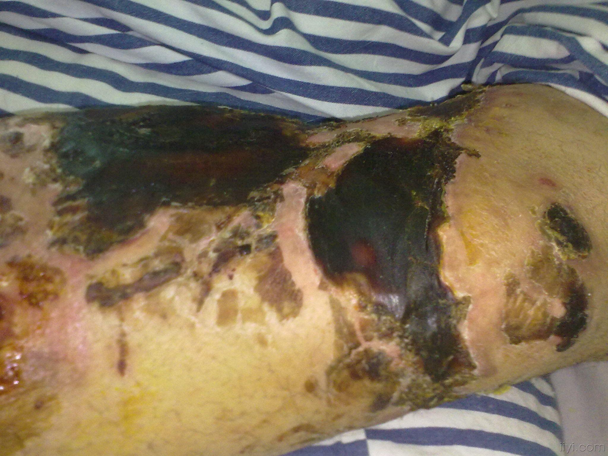 膝关节前侧皮肤坏死如何处理?