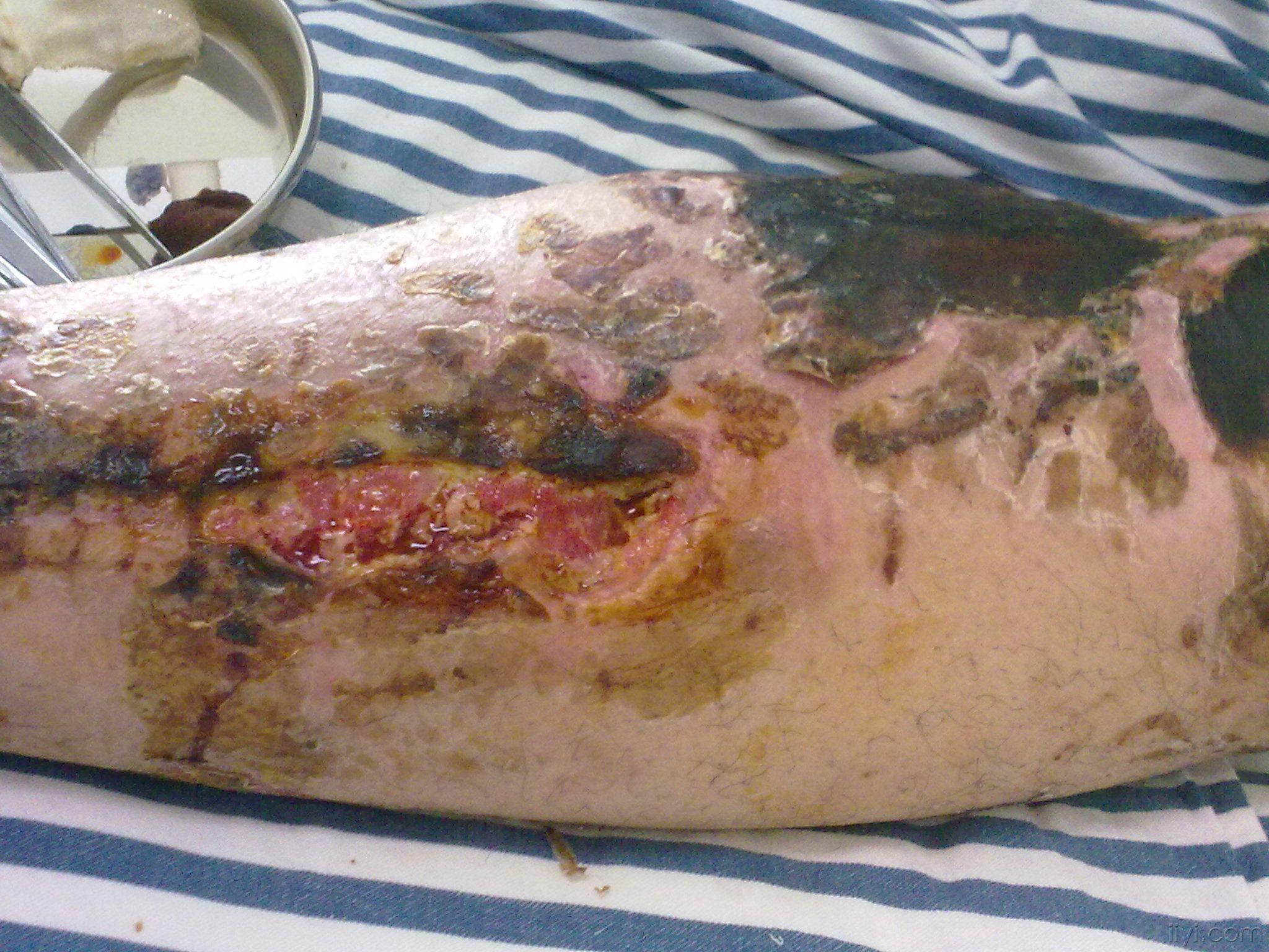 膝关节前侧皮肤坏死如何处理?